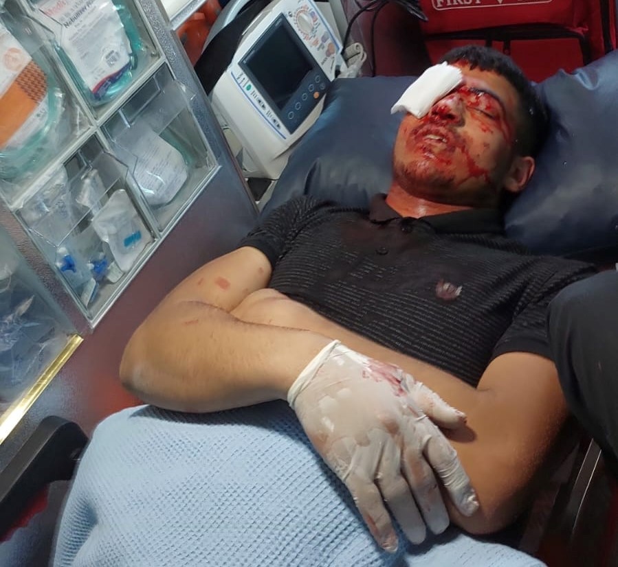 الطفل عمر عاصي بعد إصابته بشظايا قنبلة صوت في عينيه 